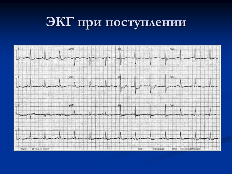 ЭКГ при поступлении